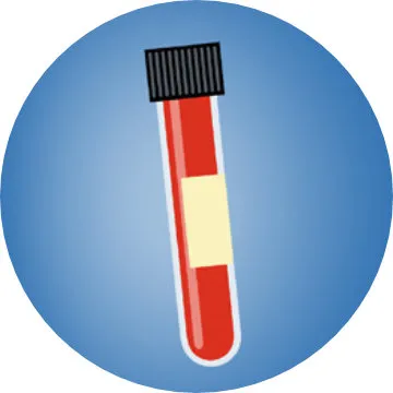 Diagnóstico epilepsia: Análisis de sangre
