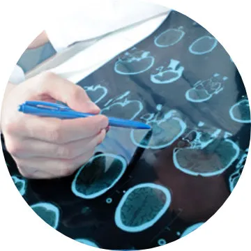 Diagnóstico epilepsia: Tomografía computarizada