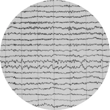 Diagnóstico epilepsia: Electroencefalograma