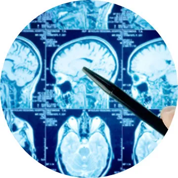 Diagnóstico epilepsia: Resonancia magnética